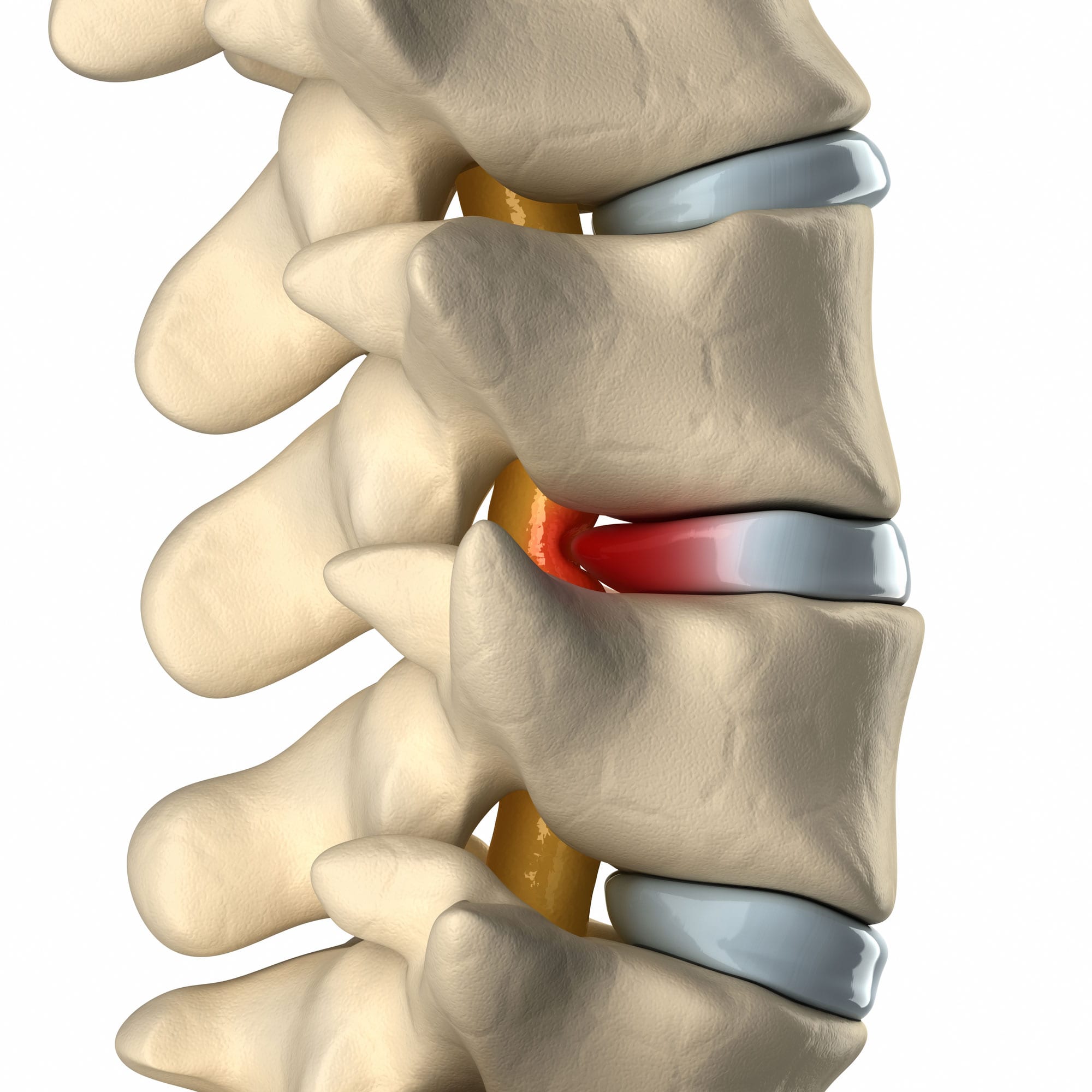 How Common Is a Pinched Nerve?